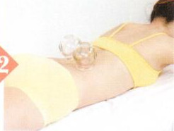 急性腰扭伤拔罐