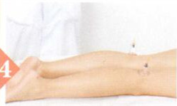 急性腰扭伤拔罐