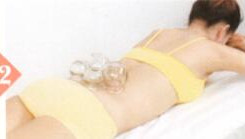 腰椎间盘突出拔罐