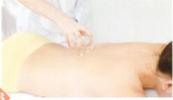 强直性脊柱炎拔罐